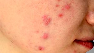 Quantas calorias em 1 Oz, Com Espinhas (Produto Após Cozinhado, Espinhas Removidas) Hadoque?